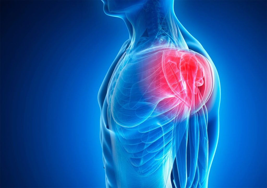 Tratamento da Tendinite do Ombro com Acupuntura